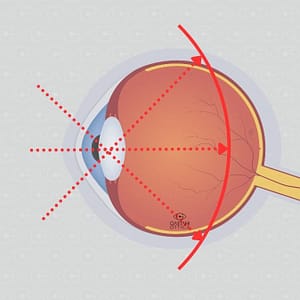 Occhio Miope Non Corretto: Immagine Esplicativa del Rischio Visivo, Approfondisci su Gaetani Ottica.